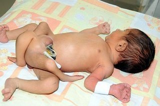 немовляті з 6 ногами провели успішну операцію
